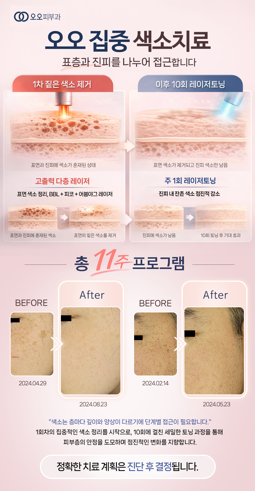 현풍오오피부과레이저토닝패키지