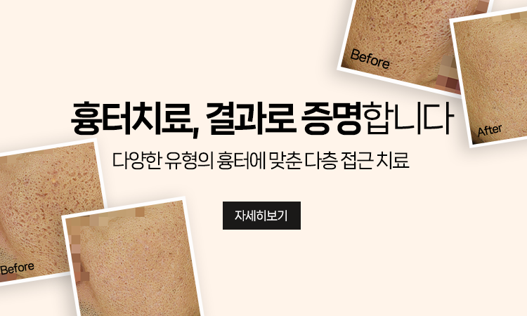 여드름흉터치료